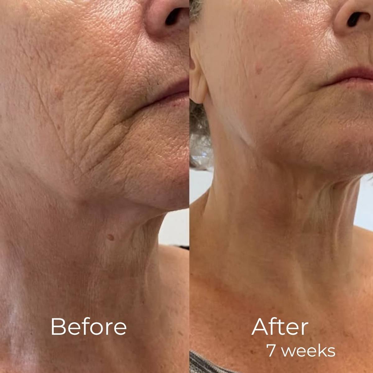 Silicon Collagen Tape