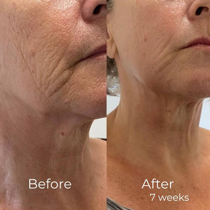Silicon Collagen Tape